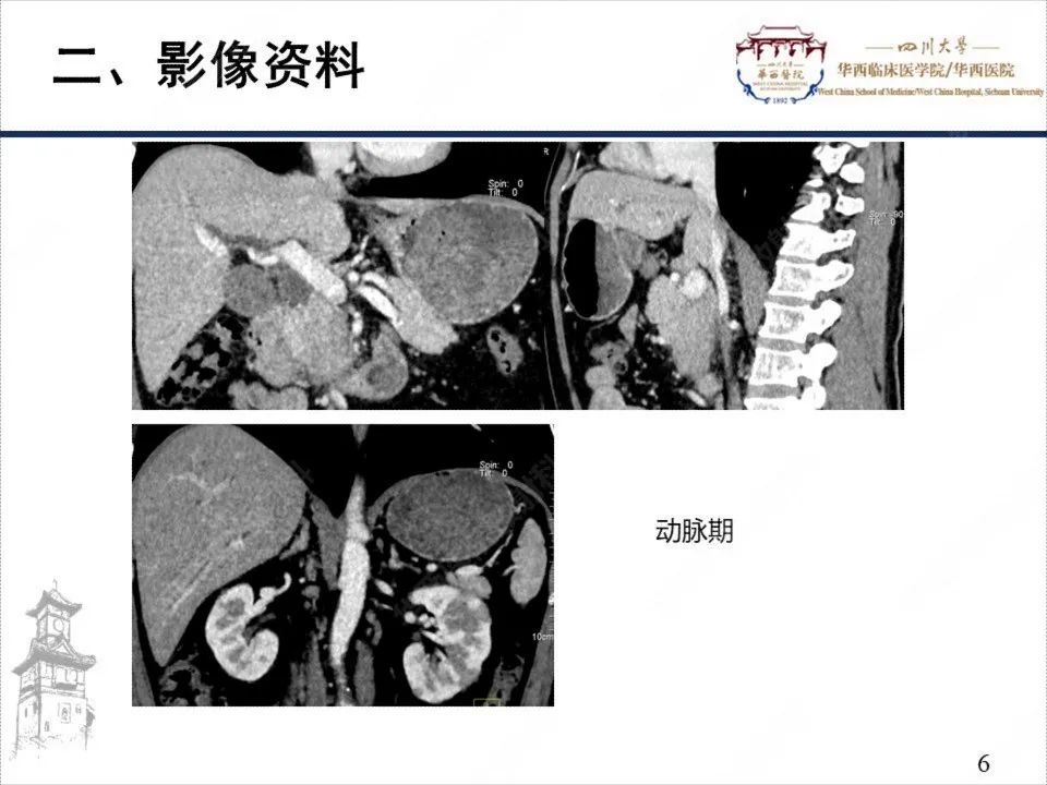 影像PPT - 【病例】自身免疫性胰腺炎1例CT影像诊断-6