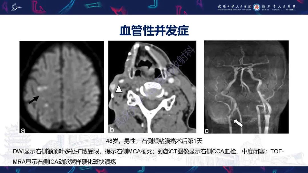 影像PPT - 【PPT】肿瘤相关中枢神经系统急症影像诊断-4