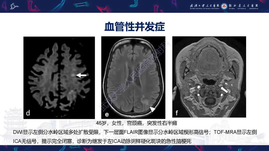 影像PPT - 【PPT】肿瘤相关中枢神经系统急症影像诊断-5