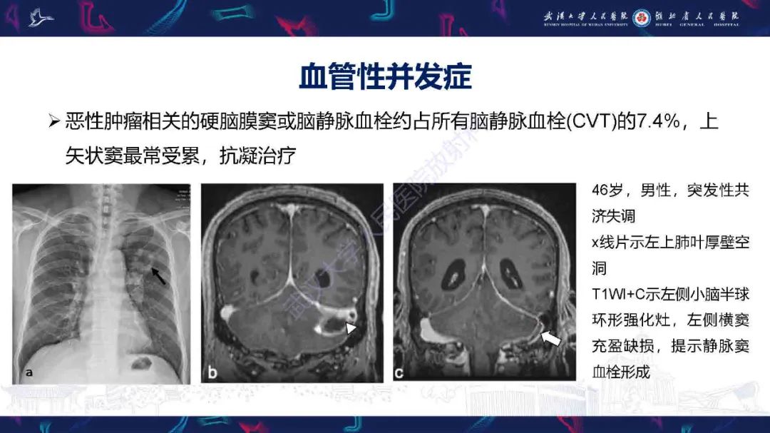 影像PPT - 【PPT】肿瘤相关中枢神经系统急症影像诊断-6