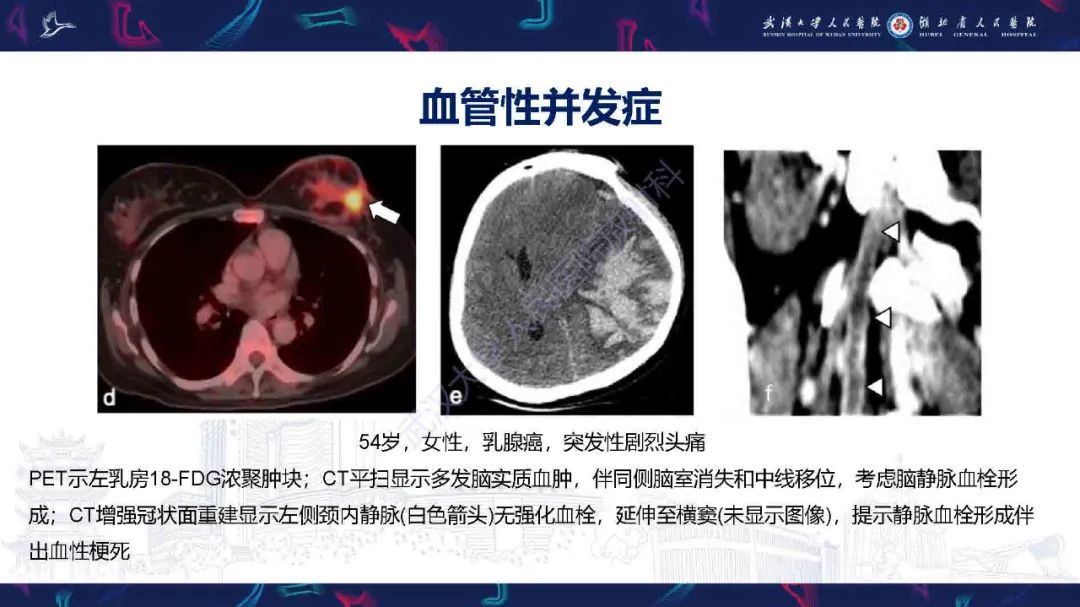 影像PPT - 【PPT】肿瘤相关中枢神经系统急症影像诊断-7