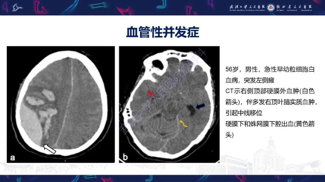 影像PPT - 【PPT】肿瘤相关中枢神经系统急症影像诊断-8