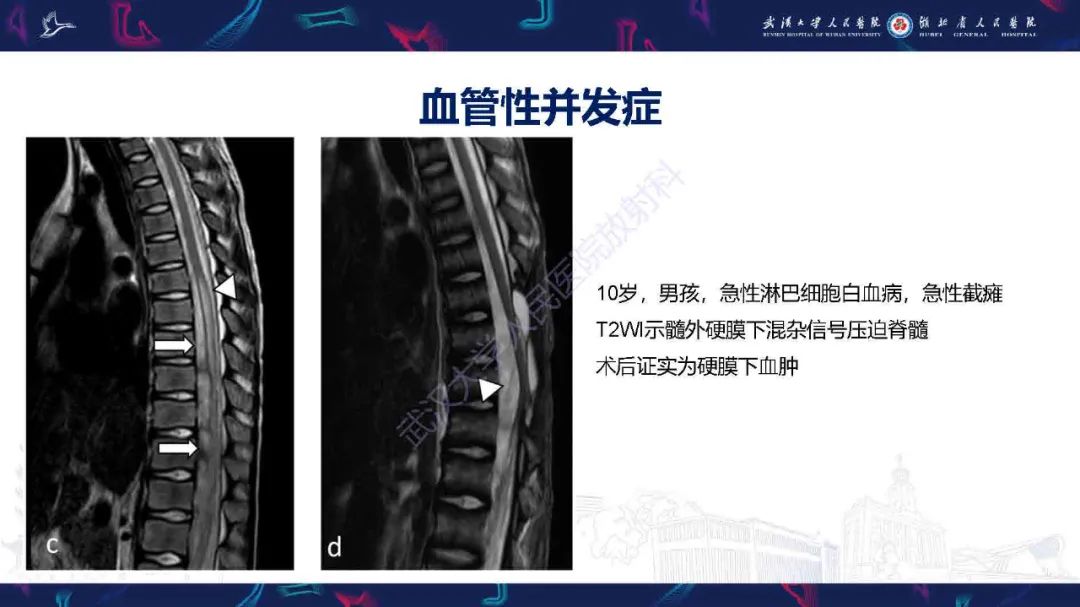 影像PPT - 【PPT】肿瘤相关中枢神经系统急症影像诊断-9