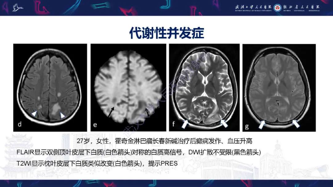 影像PPT - 【PPT】肿瘤相关中枢神经系统急症影像诊断-11