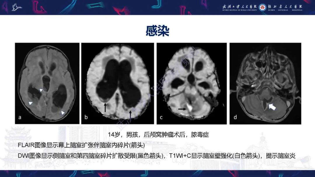 影像PPT - 【PPT】肿瘤相关中枢神经系统急症影像诊断-15