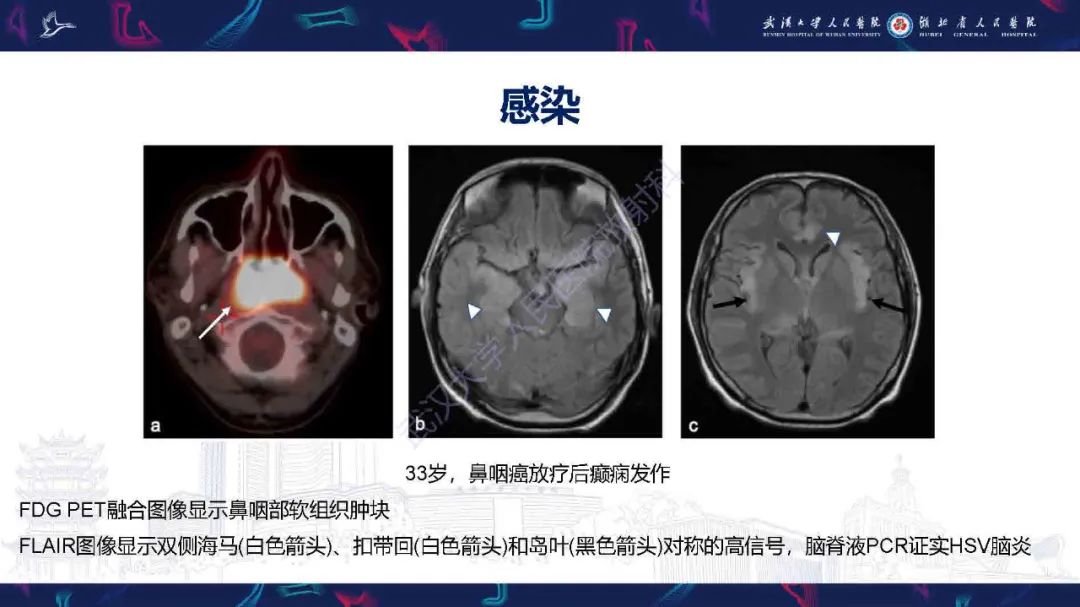 影像PPT - 【PPT】肿瘤相关中枢神经系统急症影像诊断-16