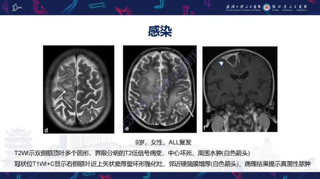 影像PPT - 【PPT】肿瘤相关中枢神经系统急症影像诊断-17