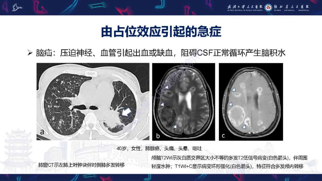 影像PPT - 【PPT】肿瘤相关中枢神经系统急症影像诊断-18