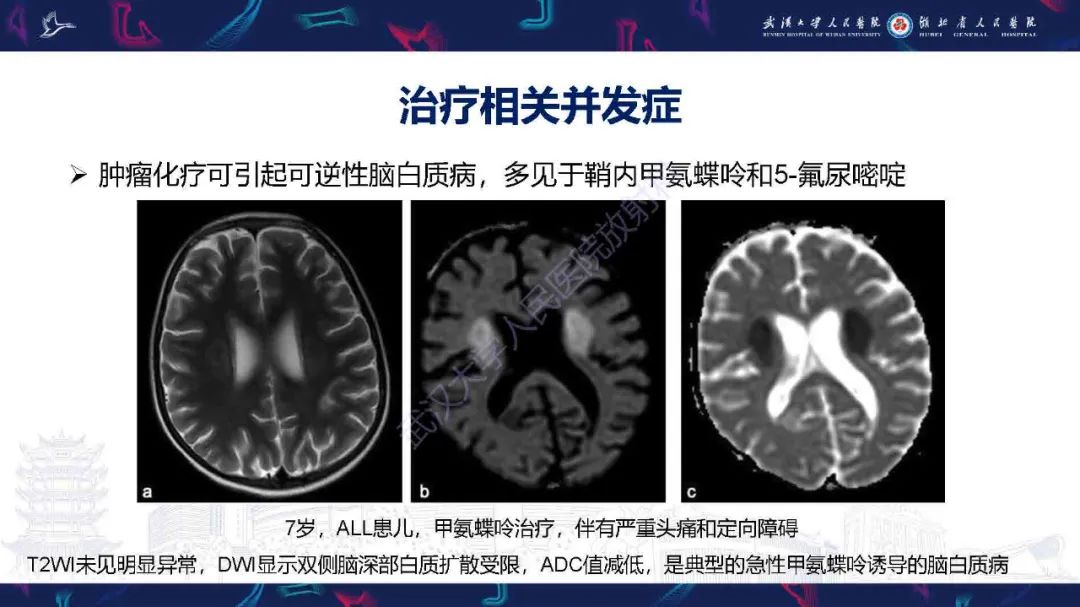 影像PPT - 【PPT】肿瘤相关中枢神经系统急症影像诊断-21