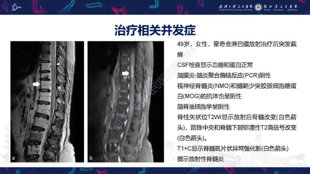 影像PPT - 【PPT】肿瘤相关中枢神经系统急症影像诊断-20