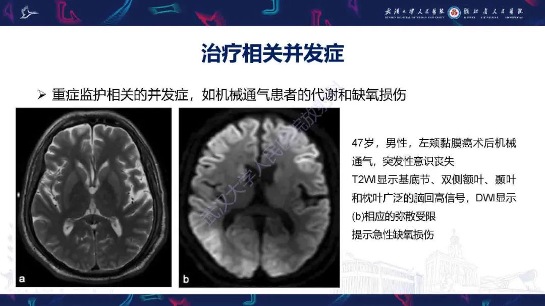 影像PPT - 【PPT】肿瘤相关中枢神经系统急症影像诊断-22