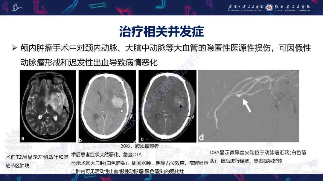影像PPT - 【PPT】肿瘤相关中枢神经系统急症影像诊断-23