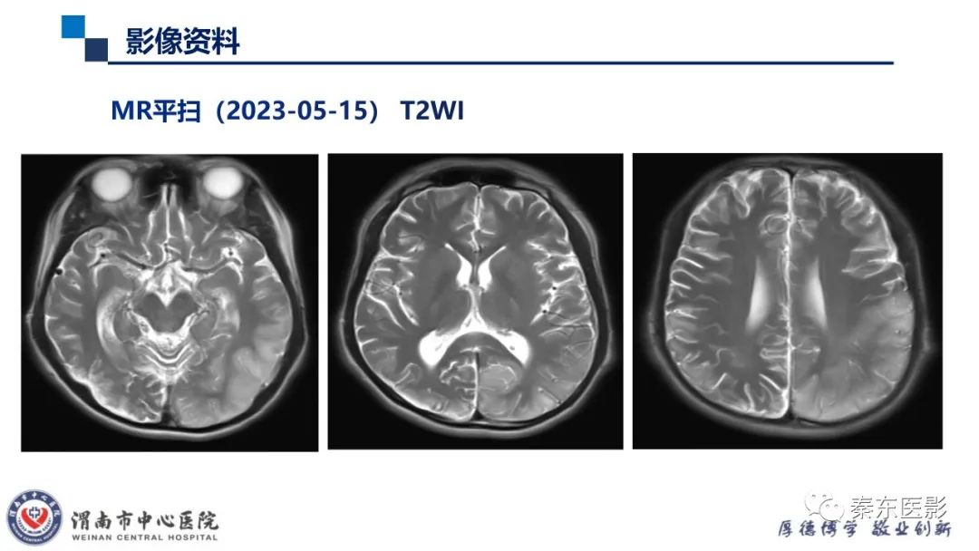 影像PPT - 【病例】线粒体脑肌病1例CT及MR影像-5