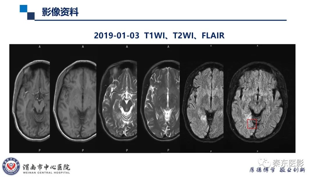 影像PPT - 【病例】线粒体脑肌病1例CT及MR影像-11