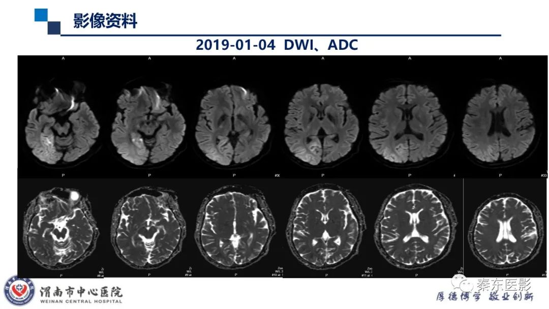 影像PPT - 【病例】线粒体脑肌病1例CT及MR影像-12