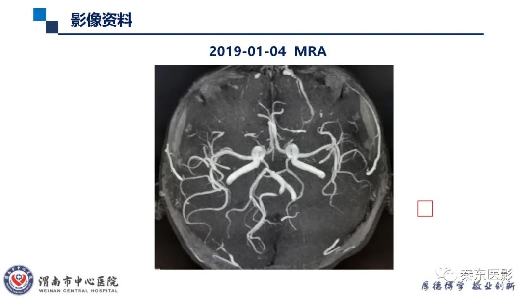 影像PPT - 【病例】线粒体脑肌病1例CT及MR影像-13