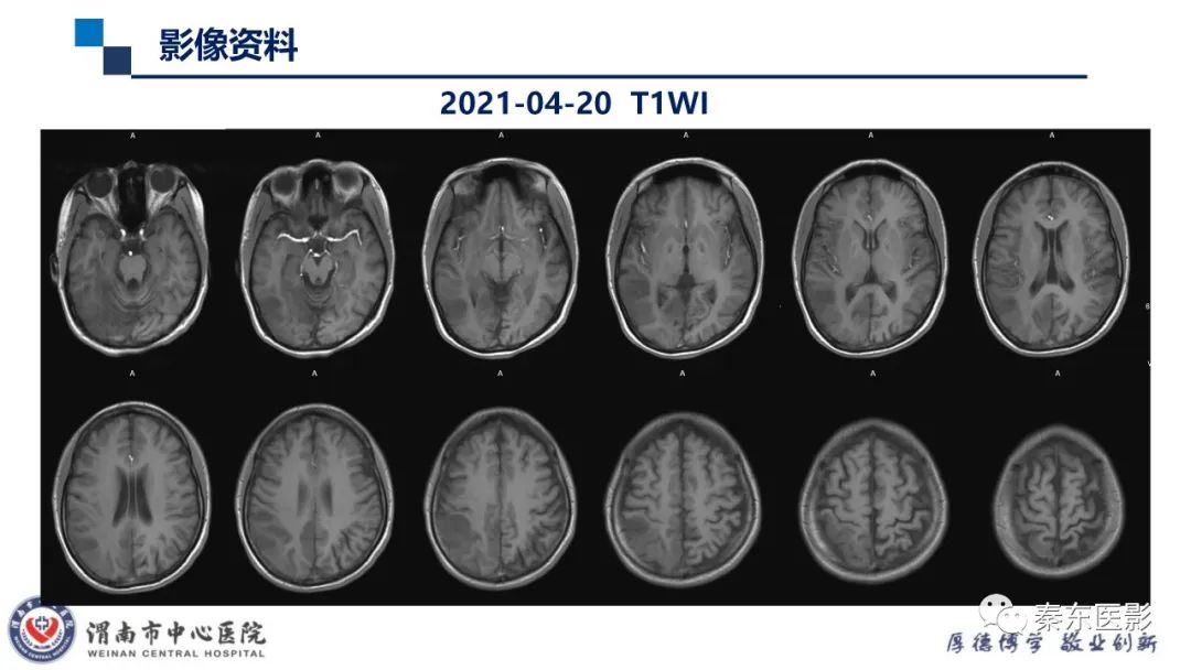 影像PPT - 【病例】线粒体脑肌病1例CT及MR影像-14