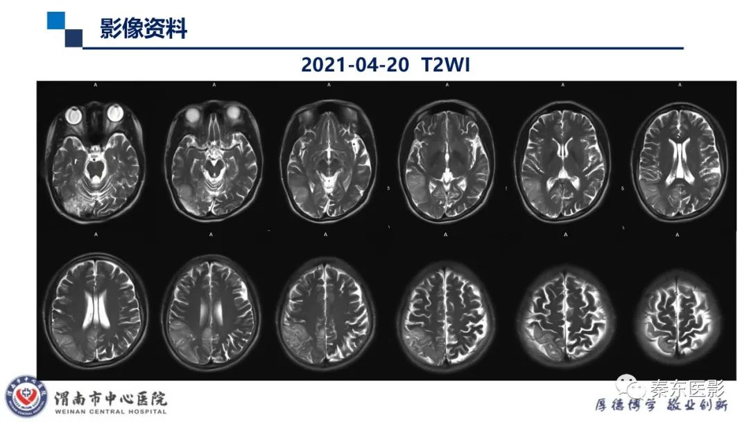 影像PPT - 【病例】线粒体脑肌病1例CT及MR影像-15