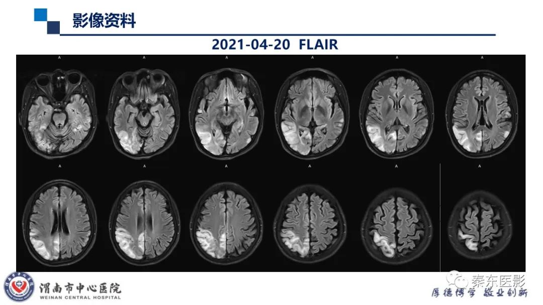 影像PPT - 【病例】线粒体脑肌病1例CT及MR影像-16