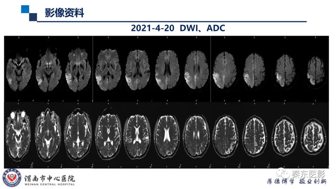 影像PPT - 【病例】线粒体脑肌病1例CT及MR影像-17
