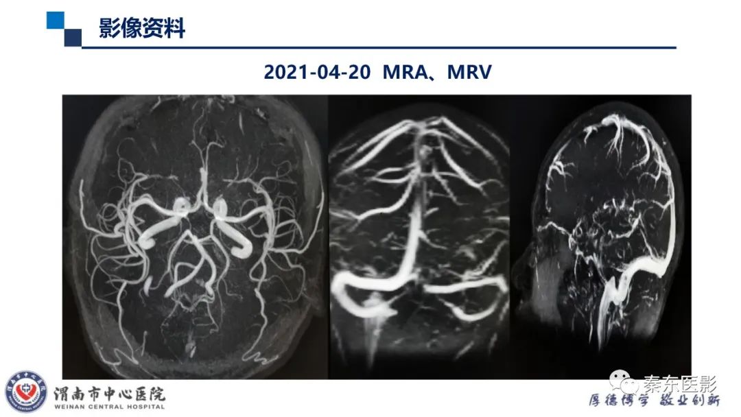 影像PPT - 【病例】线粒体脑肌病1例CT及MR影像-18