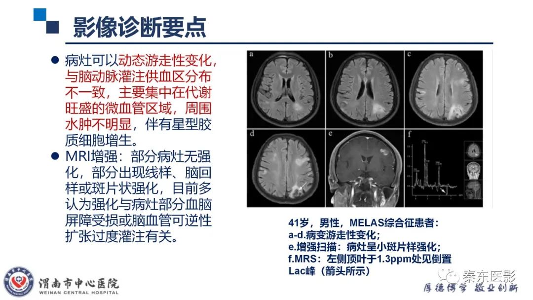 影像PPT - 【病例】线粒体脑肌病1例CT及MR影像-22