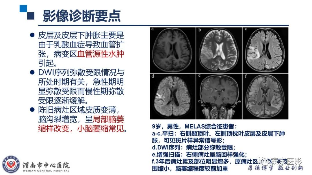 影像PPT - 【病例】线粒体脑肌病1例CT及MR影像-23