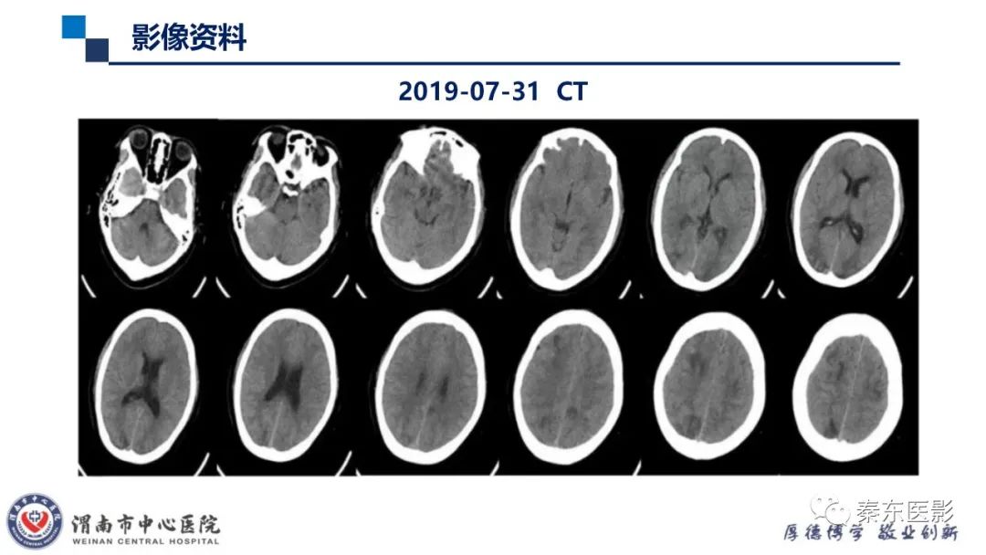 影像PPT - 【病例】线粒体脑肌病1例CT及MR影像-25