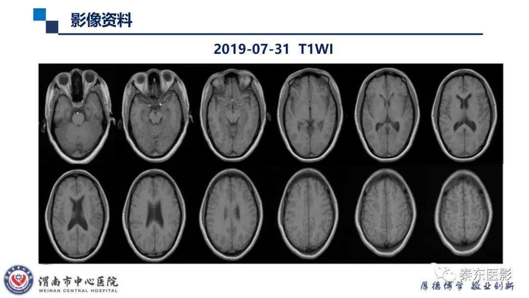 影像PPT - 【病例】线粒体脑肌病1例CT及MR影像-26