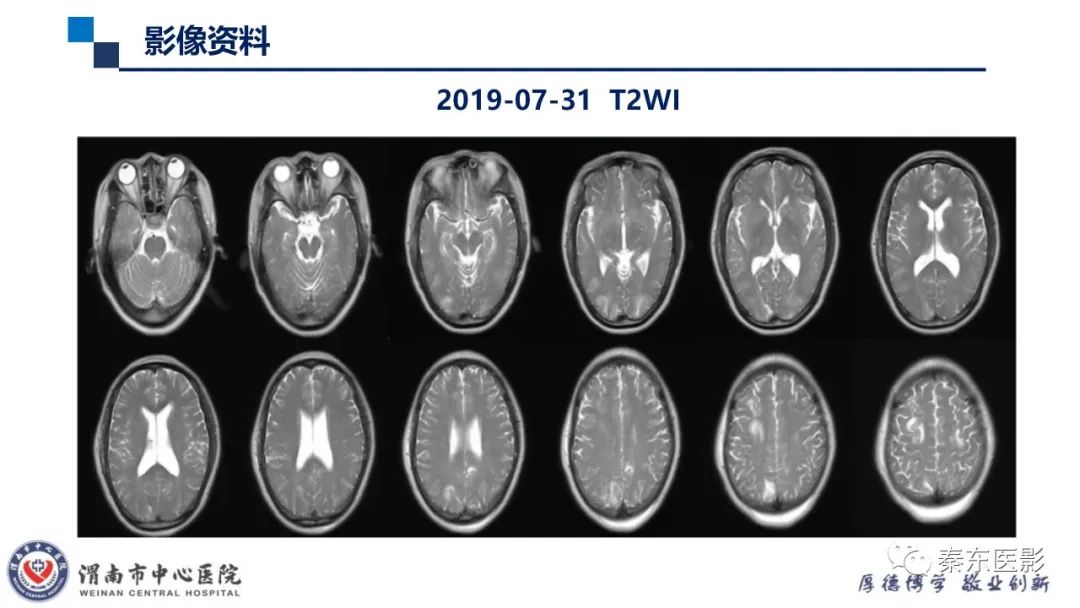 影像PPT - 【病例】线粒体脑肌病1例CT及MR影像-27
