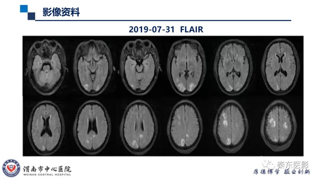 影像PPT - 【病例】线粒体脑肌病1例CT及MR影像-28