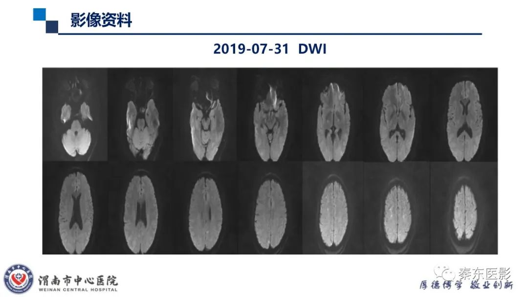 影像PPT - 【病例】线粒体脑肌病1例CT及MR影像-29