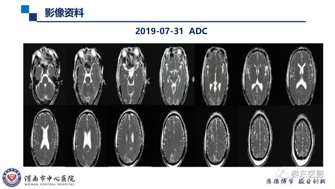 影像PPT - 【病例】线粒体脑肌病1例CT及MR影像-30