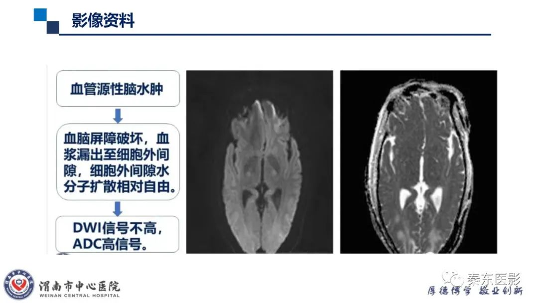 影像PPT - 【病例】线粒体脑肌病1例CT及MR影像-31