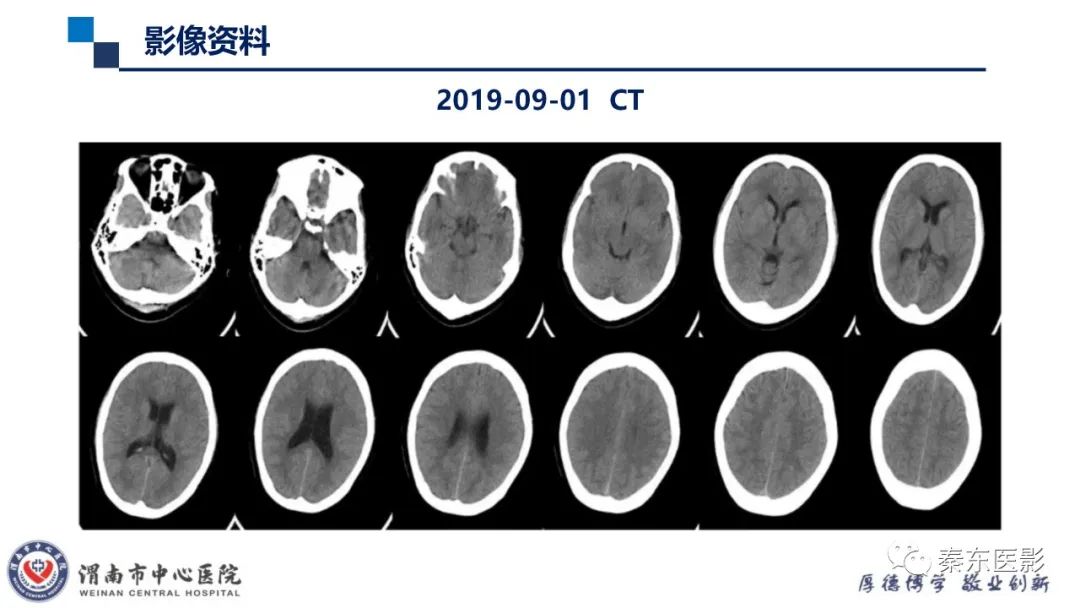 影像PPT - 【病例】线粒体脑肌病1例CT及MR影像-32
