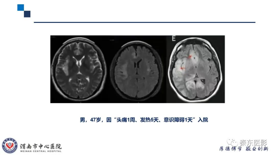 影像PPT - 【病例】线粒体脑肌病1例CT及MR影像-34