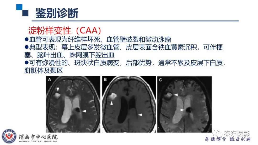 影像PPT - 【病例】线粒体脑肌病1例CT及MR影像-36