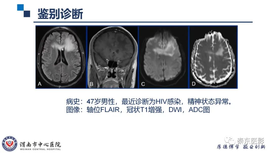 影像PPT - 【病例】线粒体脑肌病1例CT及MR影像-38