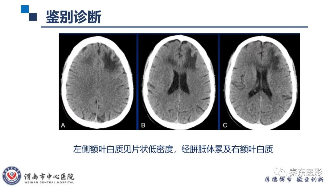 影像PPT - 【病例】线粒体脑肌病1例CT及MR影像-39