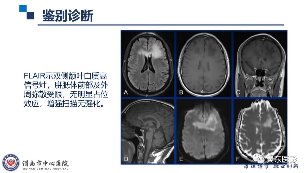 影像PPT - 【病例】线粒体脑肌病1例CT及MR影像-40