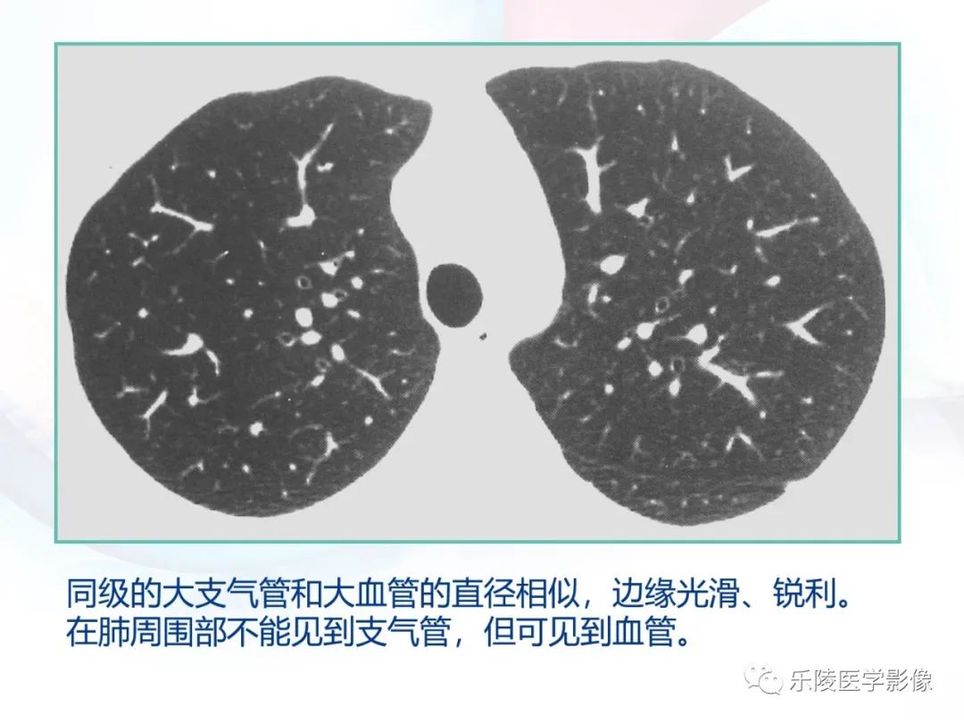影像PPT - 【PPT】肺弥漫性病变HRCT表现-7