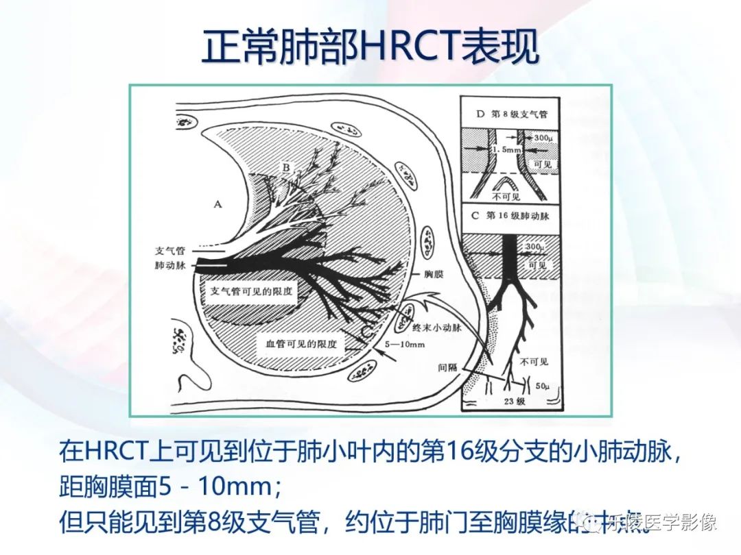 影像PPT - 【PPT】肺弥漫性病变HRCT表现-6