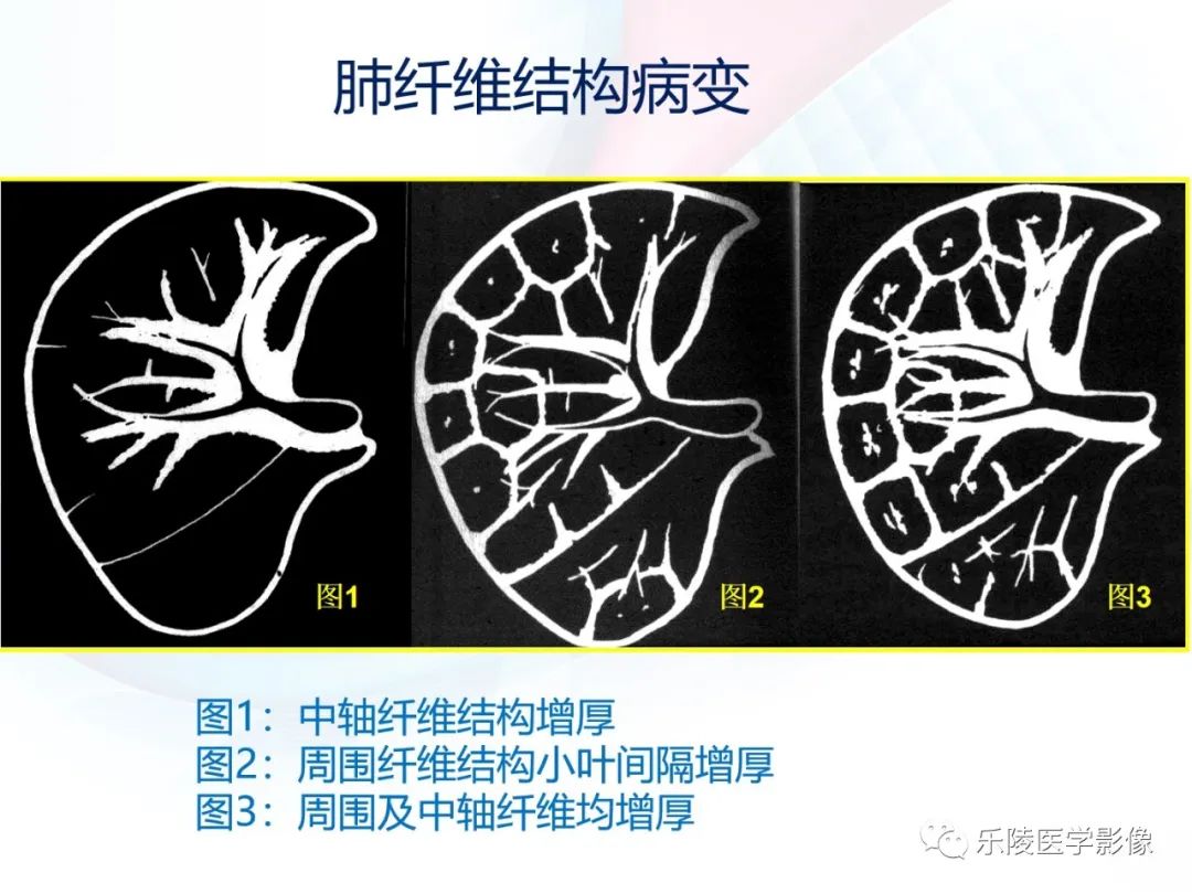 影像PPT - 【PPT】肺弥漫性病变HRCT表现-15