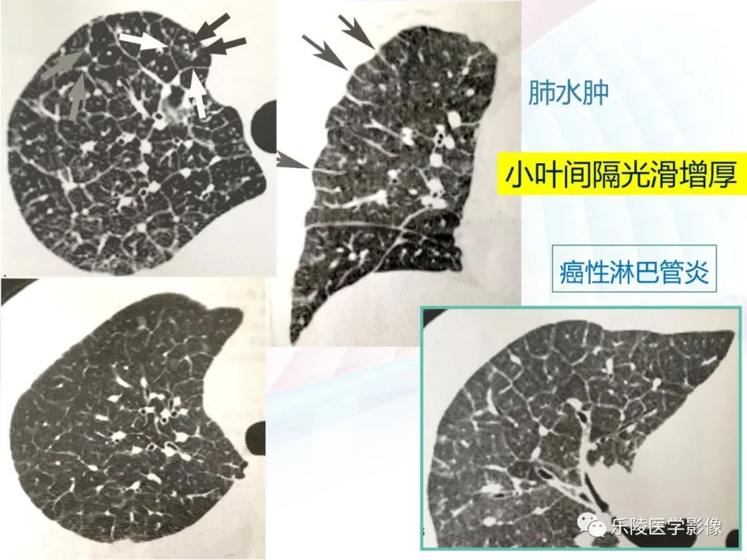 影像PPT - 【PPT】肺弥漫性病变HRCT表现-20
