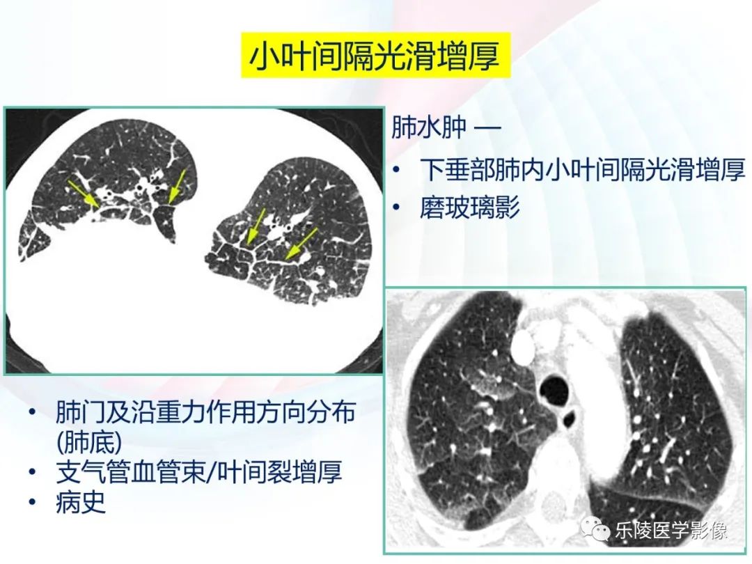 影像PPT - 【PPT】肺弥漫性病变HRCT表现-21