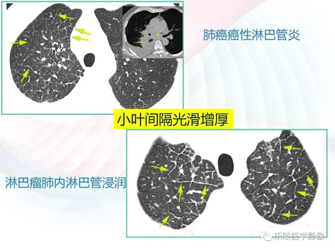 影像PPT - 【PPT】肺弥漫性病变HRCT表现-22