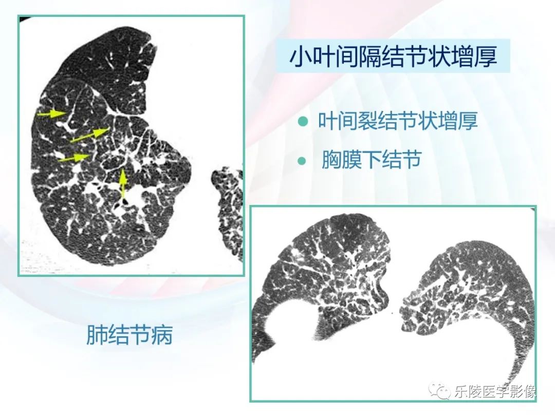 影像PPT - 【PPT】肺弥漫性病变HRCT表现-25