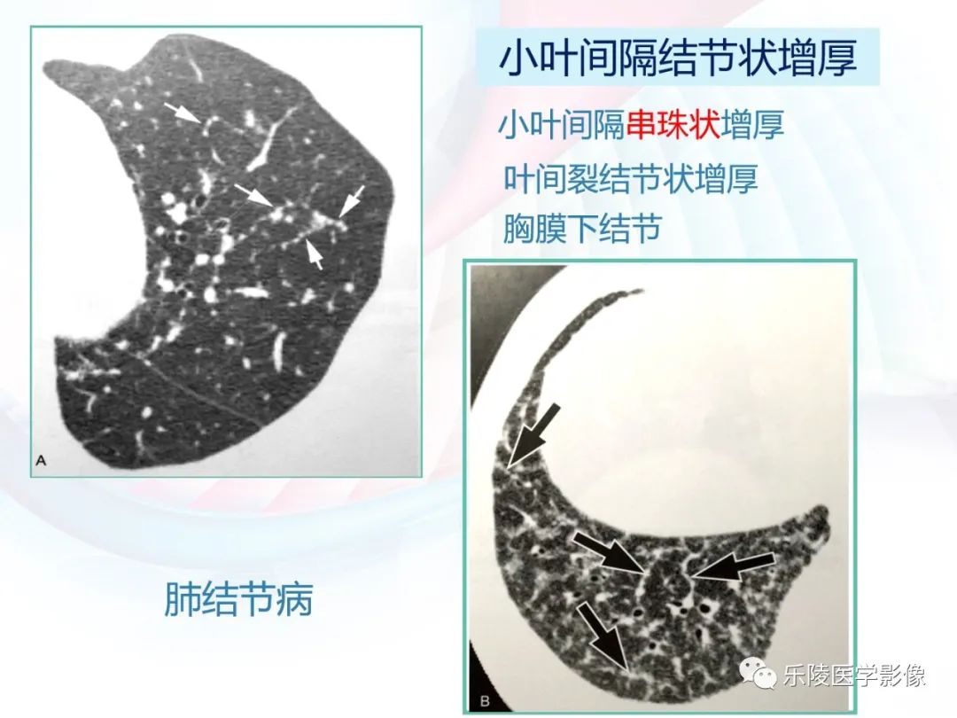 影像PPT - 【PPT】肺弥漫性病变HRCT表现-26