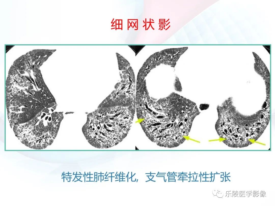 影像PPT - 【PPT】肺弥漫性病变HRCT表现-33