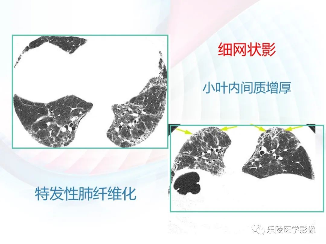 影像PPT - 【PPT】肺弥漫性病变HRCT表现-32